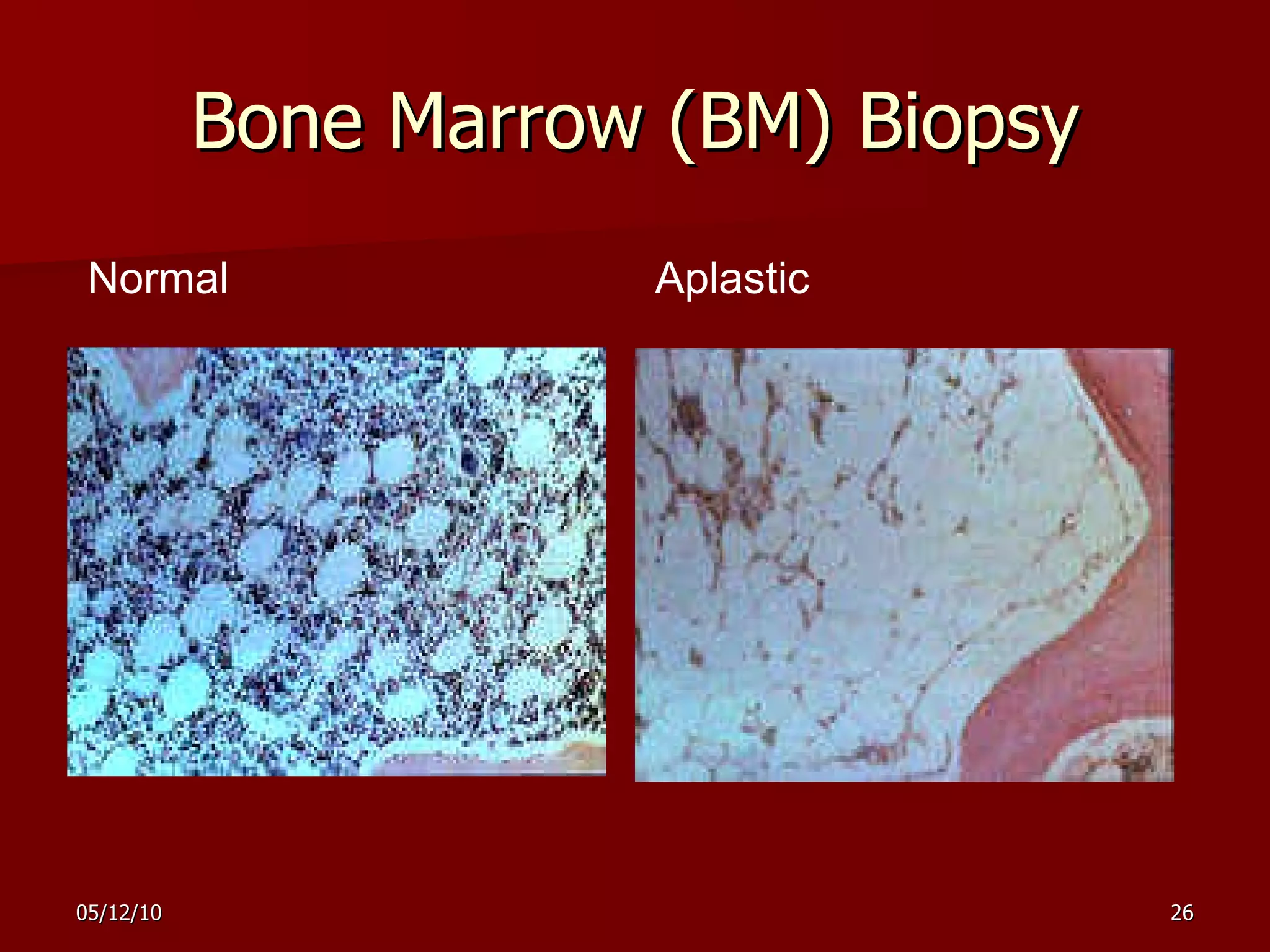 Bone Marrow (BM) Biopsy Normal Aplastic 