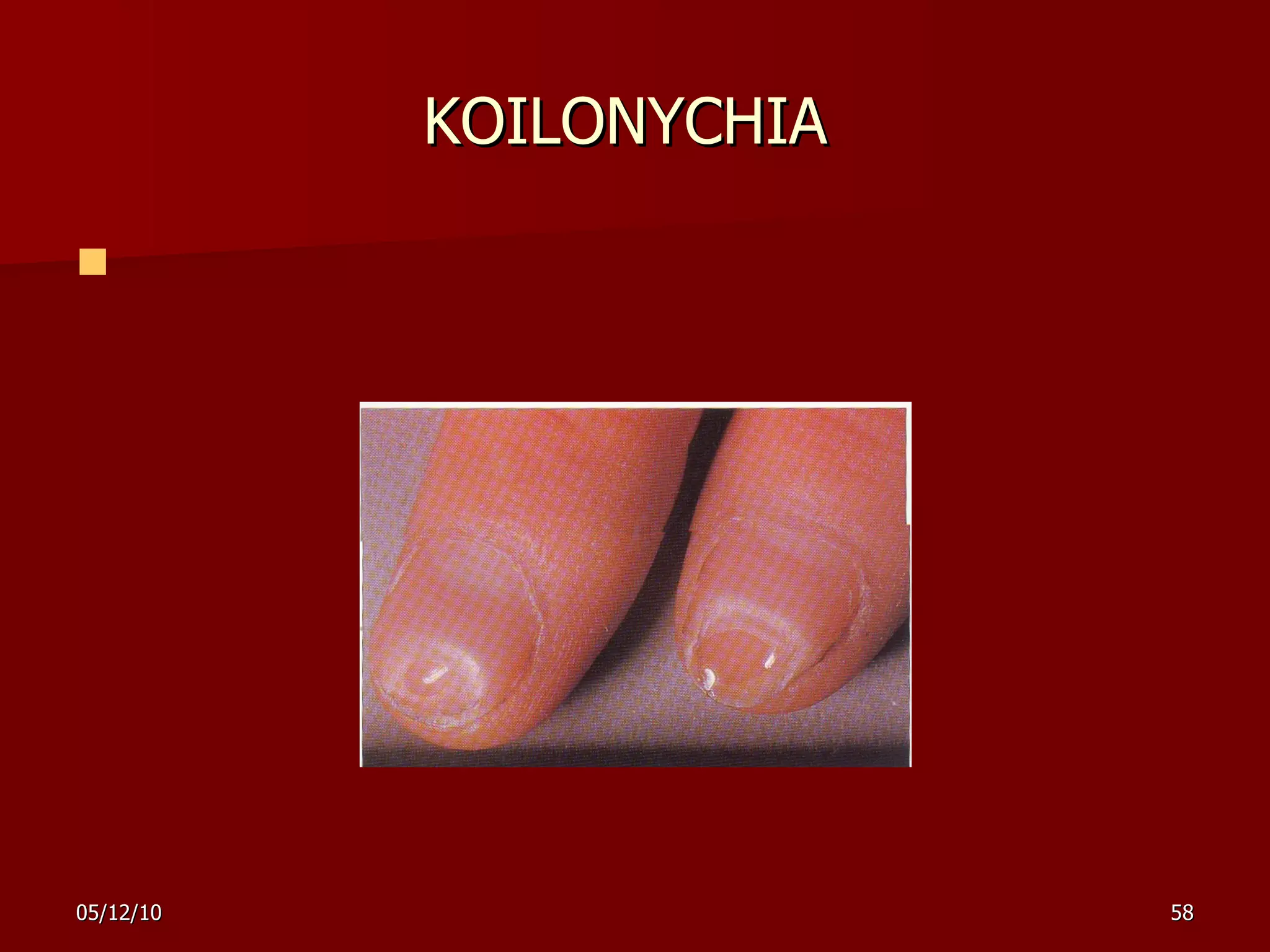 KOILONYCHIA       