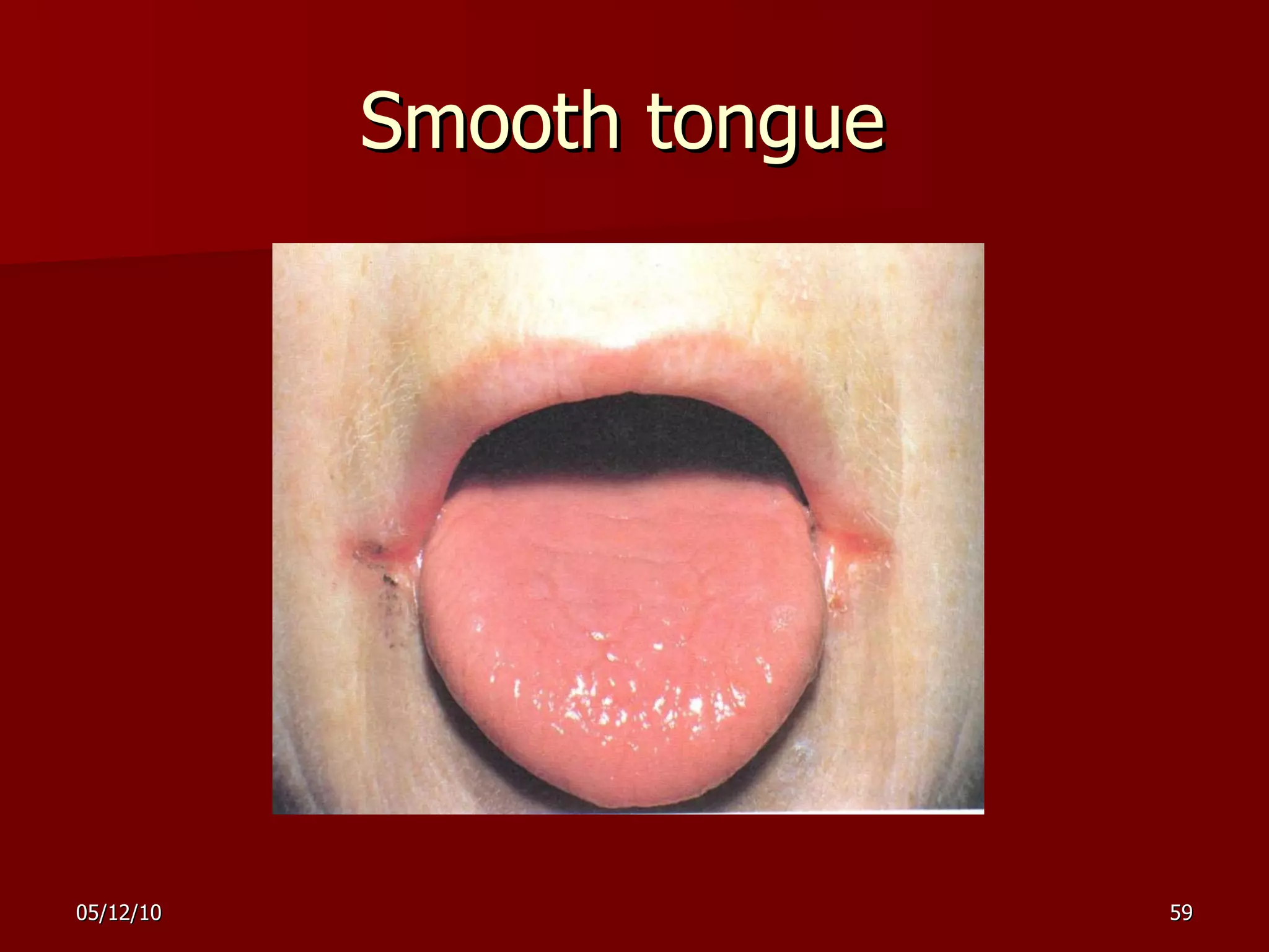 Smooth tongue  