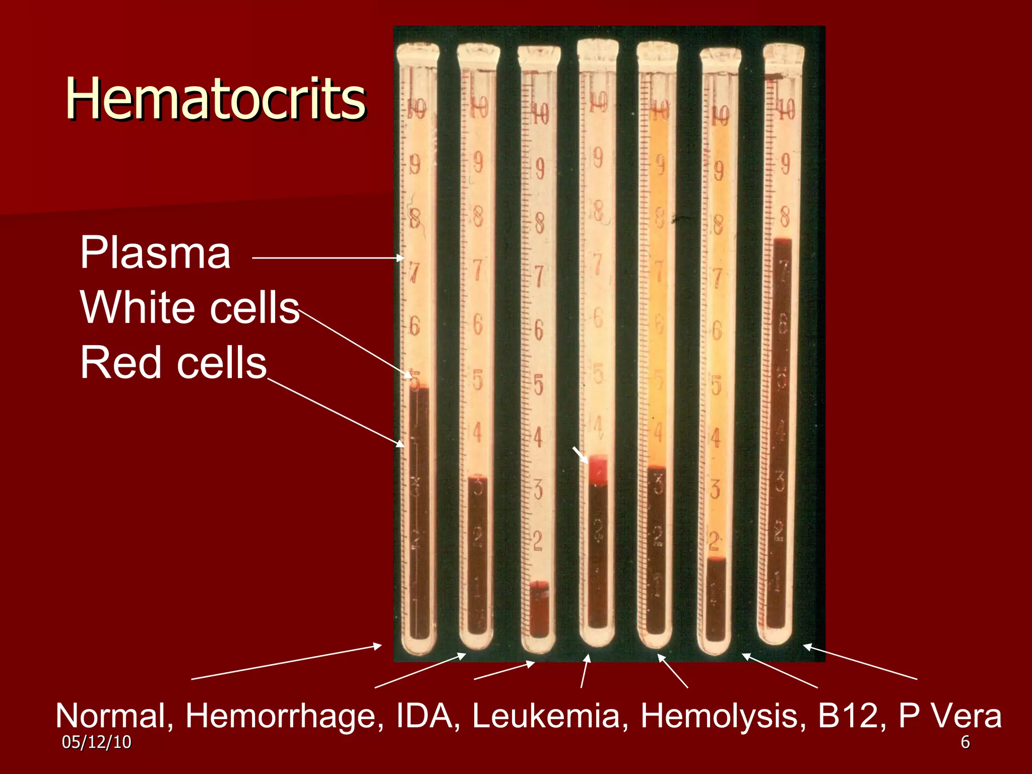 Hematocrits Normal, Hemorrhage, IDA, Leukemia, Hemolysis, B12, P Vera Plasma White cells Red cells 