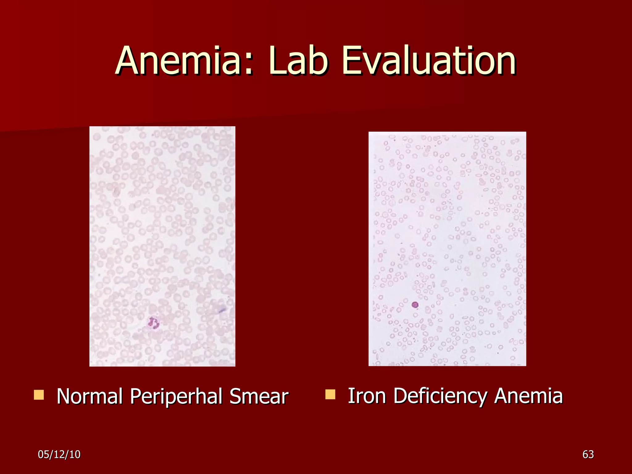 Anemia: Lab Evaluation Normal Periperhal Smear Iron Deficiency Anemia 