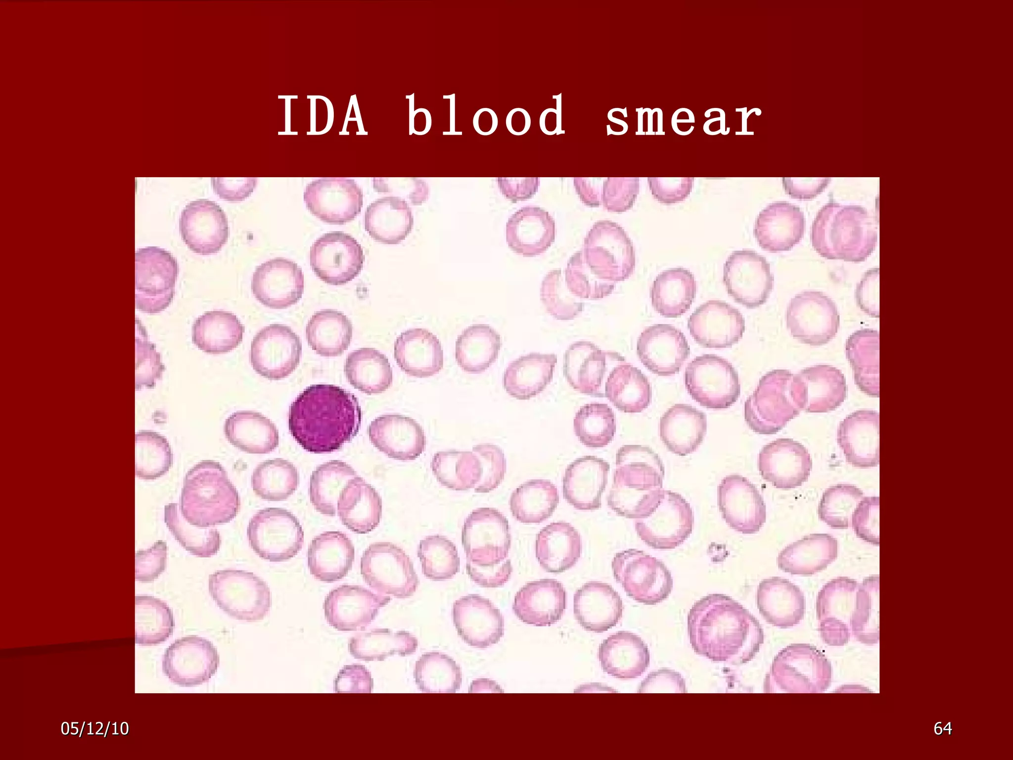 IDA blood smear 