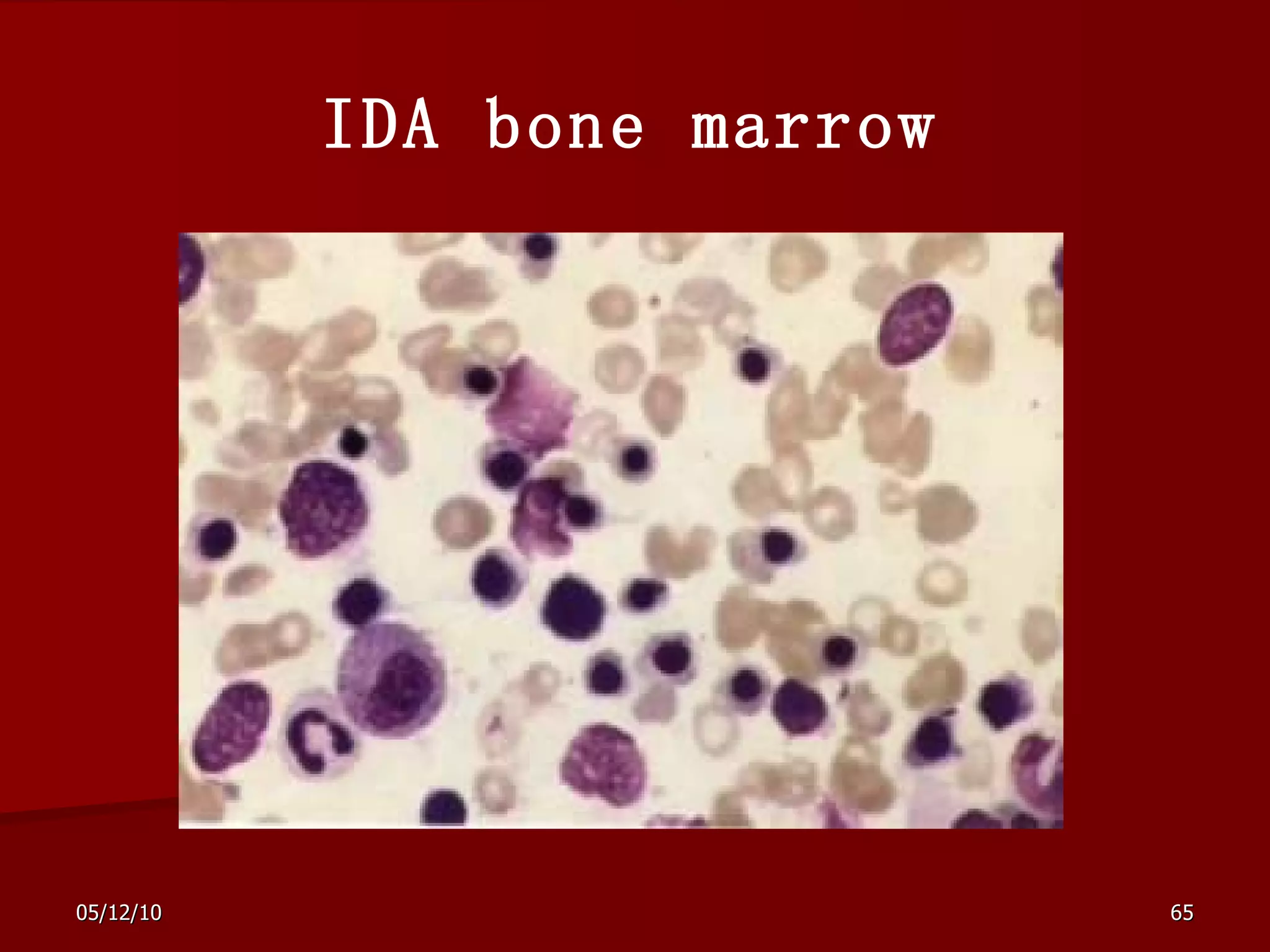 IDA bone marrow 