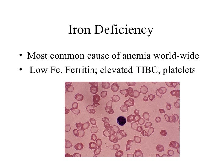 Anemia
