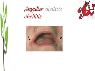 anemia-140408050251-phpapp02-2.pptxuguurur | PPTX