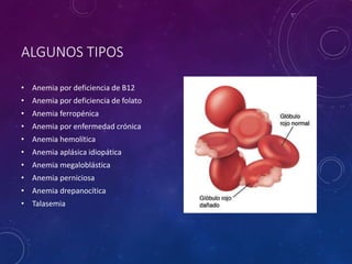 ALGUNOS TIPOS
• Anemia por deficiencia de B12
• Anemia por deficiencia de folato
• Anemia ferropénica
• Anemia por enfermedad crónica
• Anemia hemolítica
• Anemia aplásica idiopática
• Anemia megaloblástica
• Anemia perniciosa
• Anemia drepanocítica
• Talasemia
 