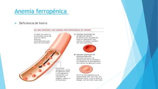 Anemia ferropénica 
 