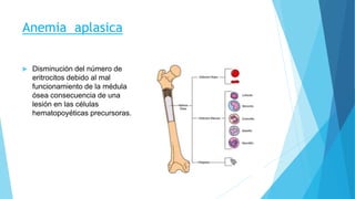 Anemia aplasica 
 Disminución del número de 
eritrocitos debido al mal 
funcionamiento de la médula 
ósea consecuencia de una 
lesión en las células 
hematopoyéticas precursoras. 
 
