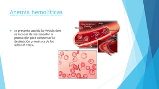 Anemia hemolíticas 
 se presenta cuando la médula ósea 
es incapaz de incrementar la 
producción para compensar la 
destrucción prematura de los 
glóbulos rojos. 
 