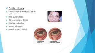  Cuadro clínico 
 Color azul en la esclerótica de los 
ojos 
 Uñas quebradizas 
 Mareo al ponerse de pie 
 Color de piel pálido 
 Lengua adolorida 
 Dificultad para respirar 
 