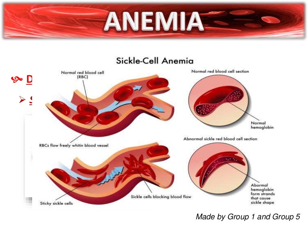 ANEMIA