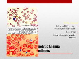 Coombs’ Negative Hemolytic Anemia
Hemoglobinopathy continues
HbC disease
•Mild hemolysis
•Splenomegaly
•Lysine substitution
•HbC crystals “bar of gold”
•Hgb electrophoresis
HbSC disease
•Sickle and SC crystals
“Washington monument”
•Less crises
•More retinopathy/aseptic
necrosis
 