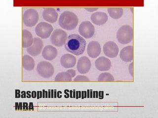 Basophilic Stippling -
MBAwww.drsarma.in
BS occurs in Lead poisoning also
 