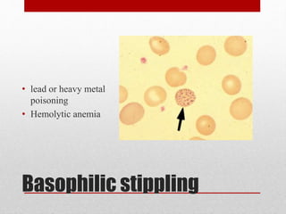 Basophilic stippling
• lead or heavy metal
poisoning
• Hemolytic anemia
 