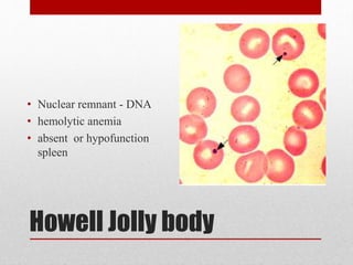 Howell Jolly body
• Nuclear remnant - DNA
• hemolytic anemia
• absent or hypofunction
spleen
 