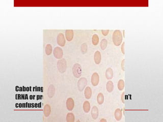 Cabot rings
(RNA or protein precipitation artifact don’t
confused with malaria)
 