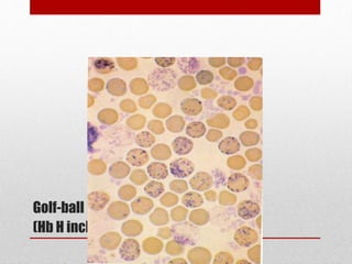 Golf-ball pattern
(Hb H inclusions)
 