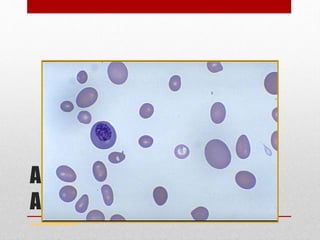 Anisocytosis - Macrocytic
Anaemia
www.drsarma.in
 