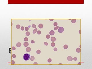 Spherocytosis
www.drsarma.in
 