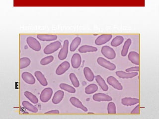 Elliptocytes
www.drsarma.in
Hereditary Elliptocytosis, B12 or Folate↓
 