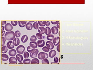 Stomatocytes
Slit like central pallor in RBC
www.drsarma.in
1. Liver Disease
2. Acute Alcoholism
3. H Stomatocyosis
4. Malignancies
 