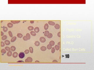 Echinocytes
Evenly distributed spicules > 10
www.drsarma.in
1. Uremia
2. Peptic ulcer
3. Gastric Ca
4. PK-D
Called Burr Cells
 