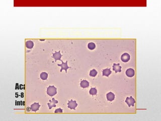 Acanthocytes
5-8 spikes of varying length, irregular
intervals
www.drsarma.in
Called Spur Cells, Occur in A H A
 