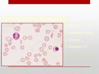 Shistocytes
www.drsarma.in
1. MAHA
2. Prosthetic valves
3. Uremia
4. Malignant HT
Fragmented, Helmet or triangle shaped RBC
 
