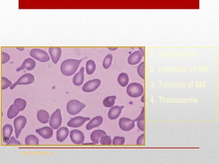 Tear Drop Cells
www.drsarma.in
1. Myelofibosis
2. Infiltration of BM
3. Tumours of BM
4. Thalassemia
 
