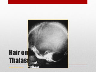 Hair on end -
Thalassemia Major
www.drsarma.in
 