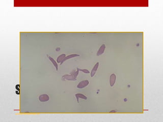 Sickle Cell Anaemia
www.drsarma.in
 