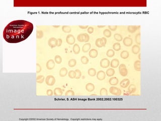Copyright ©2002 American Society of Hematology. Copyright restrictions may apply.
Schrier, S. ASH Image Bank 2002;2002:100325
Figure 1. Note the profound central pallor of the hypochromic and microcytic RBC
 