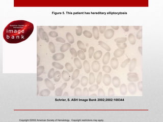 Copyright ©2002 American Society of Hematology. Copyright restrictions may apply.
Schrier, S. ASH Image Bank 2002;2002:100344
Figure 5. This patient has hereditary elliptocytosis
 