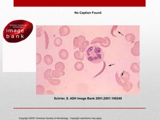 Copyright ©2001 American Society of Hematology. Copyright restrictions may apply.
Schrier, S. ASH Image Bank 2001;2001:100248
No Caption Found
 
