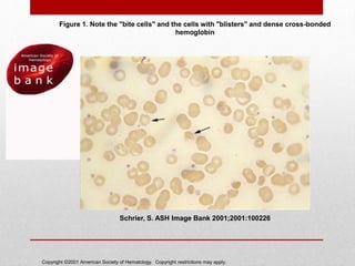 Copyright ©2001 American Society of Hematology. Copyright restrictions may apply.
Schrier, S. ASH Image Bank 2001;2001:100226
Figure 1. Note the "bite cells" and the cells with "blisters" and dense cross-bonded
hemoglobin
 