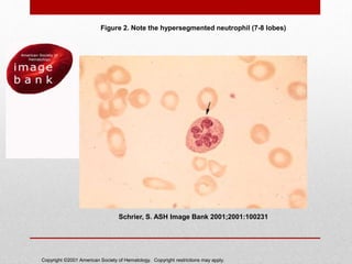 Copyright ©2001 American Society of Hematology. Copyright restrictions may apply.
Schrier, S. ASH Image Bank 2001;2001:100231
Figure 2. Note the hypersegmented neutrophil (7-8 lobes)
 
