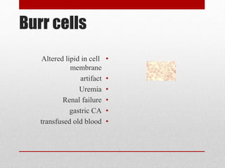 Burr cells
•Altered lipid in cell
membrane
•artifact
•Uremia
•Renal failure
•gastric CA
•transfused old blood
 