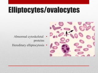 Elliptocytes/ovalocytes
•Abnormal cytoskeletal
proteins
•Hereditary elliptocytosis
 