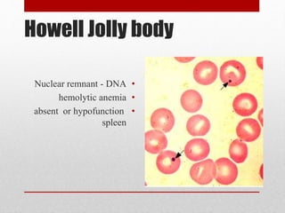 Howell Jolly body
•Nuclear remnant - DNA
•hemolytic anemia
•absent or hypofunction
spleen
 