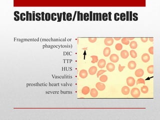 Schistocyte/helmet cells
•Fragmented (mechanical or
phagocytosis)
•DIC
•TTP
•HUS
•Vasculitis
•prosthetic heart valve
•severe burns
 