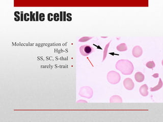 Sickle cells
•Molecular aggregation of
Hgb-S
•SS, SC, S-thal
•rarely S-trait
 