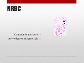 NRBC
•Common in newborn
•severe degree of hemolysis
 