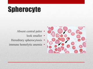 Spherocyte
•Absent central palor
•look smaller
•Hereditary spherocytosis
•immune hemolytic anemia
 