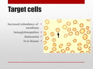 Target cells
•Increased redundancy of
membrane
•hemoglobinopathies
•thalassemia
•liver disease
 