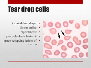 Tear drop cells
•Distorted drop shaped
•Smear artifact
•myelofibrosis
•promyeloblastic leukemia
•space occupying lesions of
marrow
 