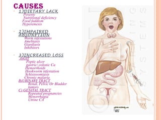 CAUSES• 1)DIETARY LACK
Poverty
Nutritional deficiency
Food faddism
Hyperemesis
• 2)IMPAIRED
ABSORPTION
Worm infestations
Amebiasis
Giardiasis
Inhibitors
• 3)INCREASED LOSS
A)GIT
Peptic ulcer
gastric/ colonic Ca
Hemorrhoids
Hookworm infestation
Schistosomiasis
Chronic malaria
B)URINARY TRACT
Renal, Pelvic Or Bladder
tumors
C) GENITAL TRACT
Repeated pregnancies
Menorrhagia
Utrine CA
 