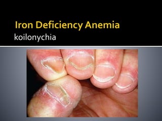 koilonychia
 