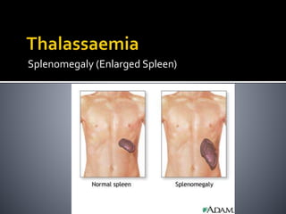 Splenomegaly (Enlarged Spleen)
 