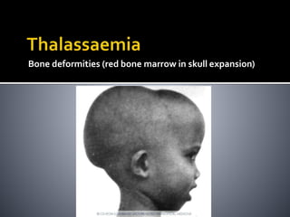 Bone deformities (red bone marrow in skull expansion)
 