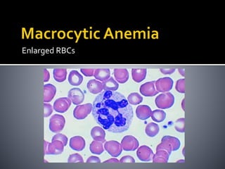 Enlarged RBCs
 